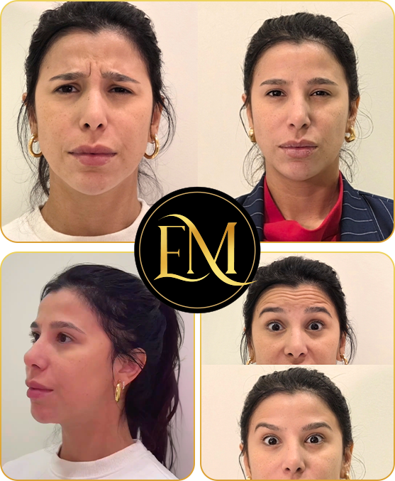 Resultado de procedimento estético facial com traços preservados